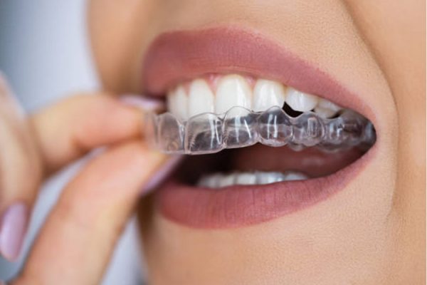 Aligners