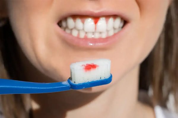 Bleeding Gum Disease