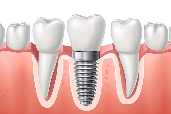 Dental Implants