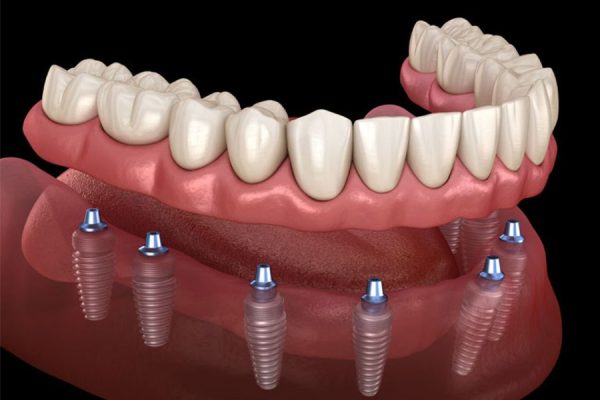 Full Mouth Rehabilitation