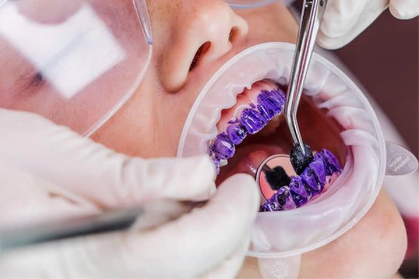 Guided Biofilm Therapy