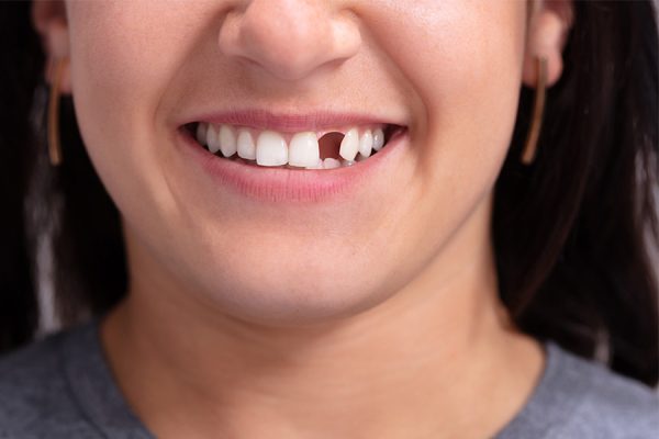 Missing Teeth Replacement