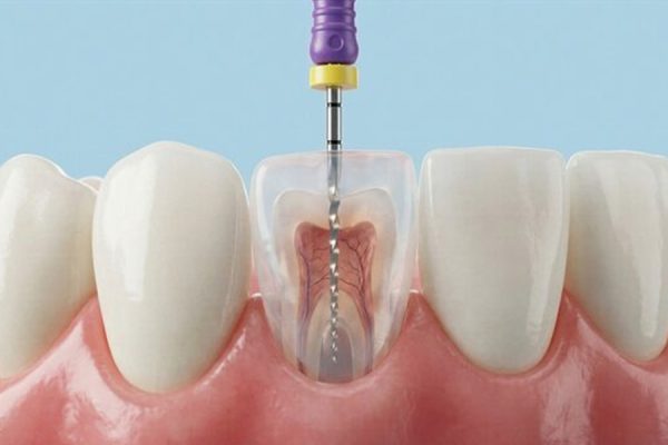 Root Canal Treatment