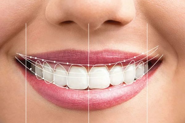 Smile Makeover