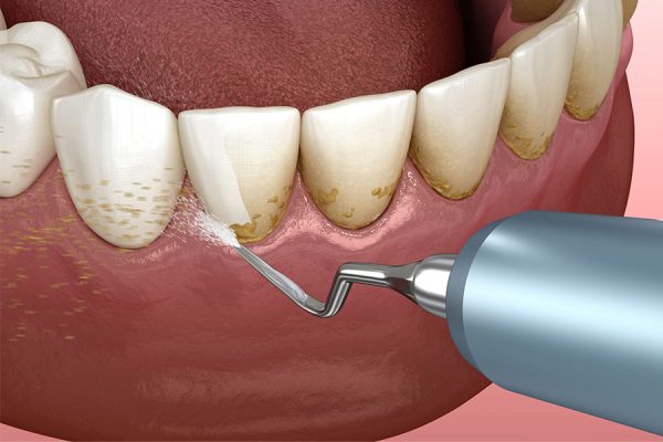 Teeth Cleaning