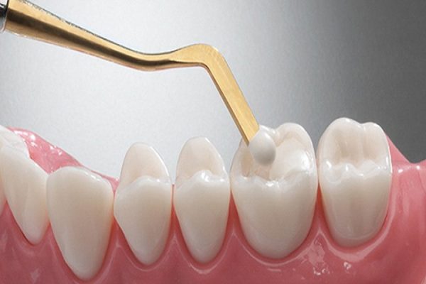 Tooth Coloured Fillings