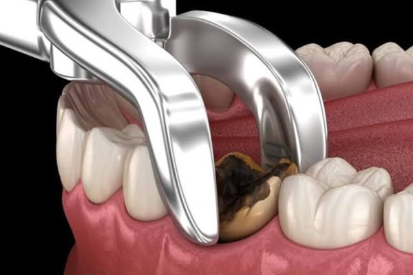 Tooth Removal