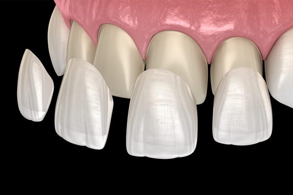 Veneers
