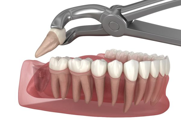 Wisdom Tooth Removal